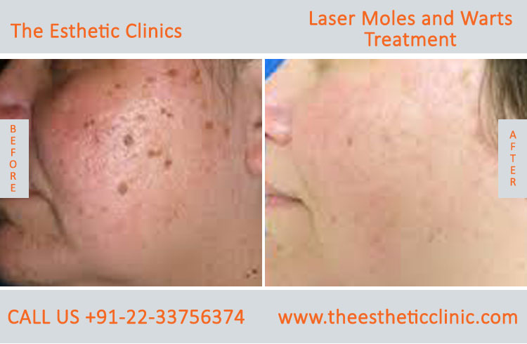 Moles Wart Skin Tags Laser Treatment before after photos in mumbai india (3)